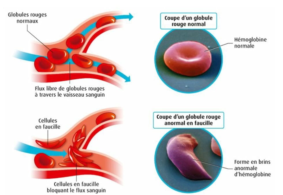 globules